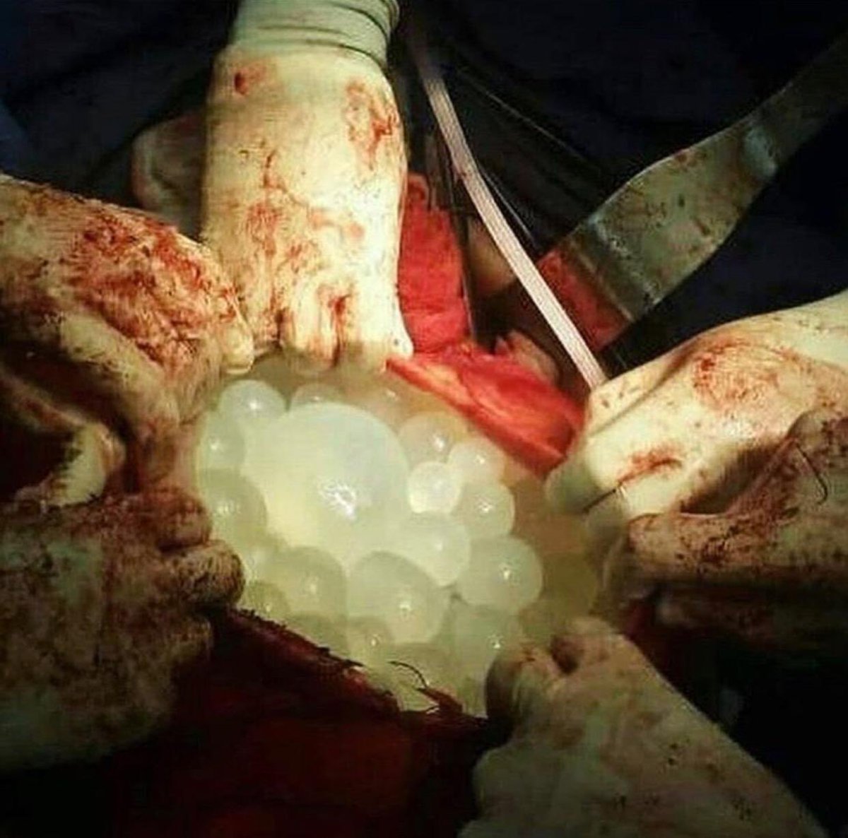 drkeithsiau's tweet photo. An unusual finding during abdominal surgery for a patient with abdominal distension. What’s the diagnosis? https://t.co/ctCmJCzKd3