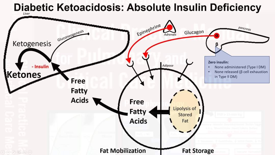 LandsbergManual's tweet photo. Ketoacidosis ONLY occurs in 3 metabolic scenarios, DM with Absolute or Relative Insulin Deficiency, and Alcoholism with Starvation #internalmedicine #hospitalist #emergencymedicine #criticalcare #pulmonary #endocrinology #diabetes #Meded #MedTwitter #dka #anesthesia PRTIYL https://t.co/f0VSWx4f3Z