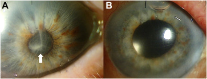 Images show complete fibrin degradation in the anterior chamber 1 day following intracameral alteplase injection in the setting of endophthalmitis being treated with tap and inject. <a href="/PhilipDockery/">Philip Dockery, MD MPH</a> ow.ly/fBPv50Nk12G