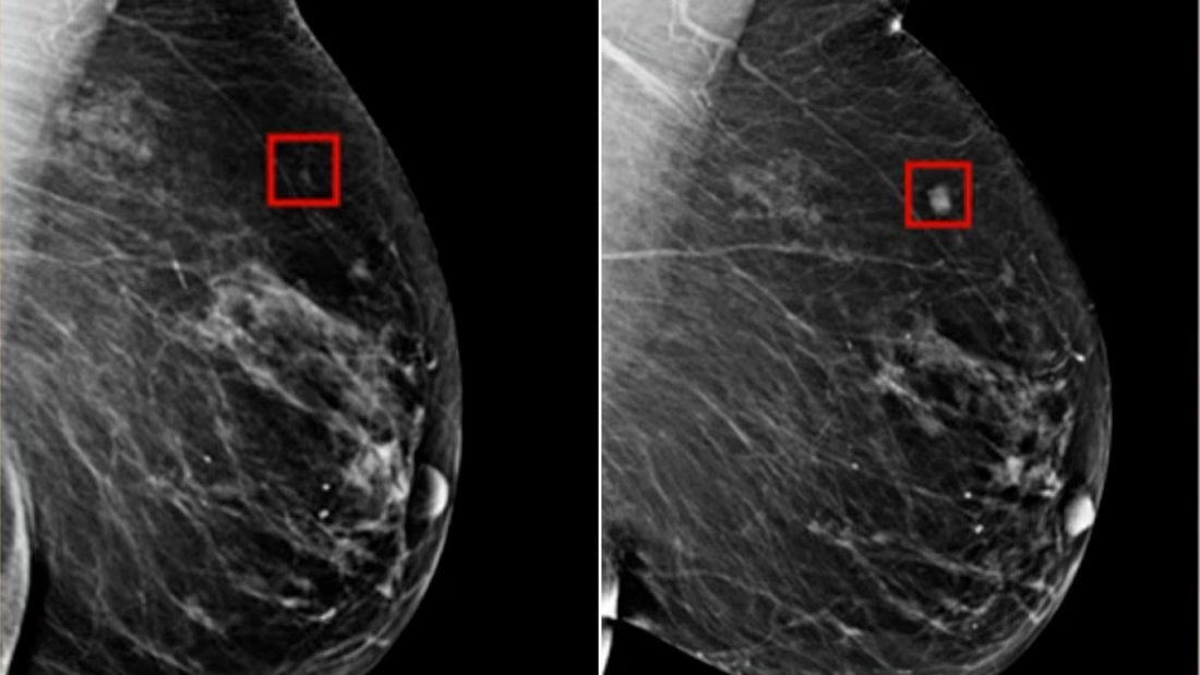 Cultination1's tweet photo. L'intelligence artificielle a pu détecter un cancer du sein chez une patiente, 4 ans avant qu'il ne soit diagnostiqué par des radiologues humains. https://t.co/aQrIShBQkV