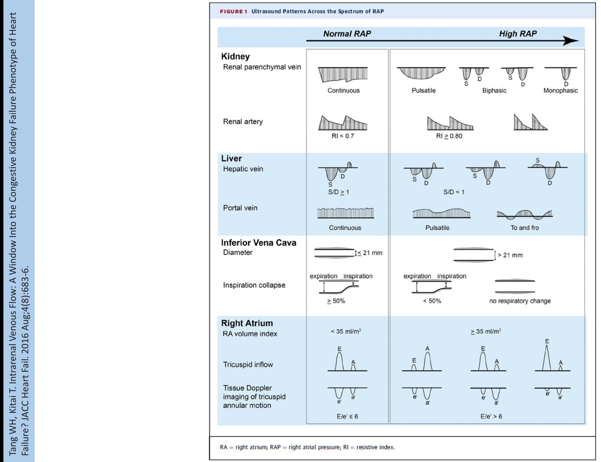 PEPJLHC's tweet photo. Evaluation of congestión , now days nephrologist use more tools. Ultrasound
Biomarkers
Clinical exploration and dry weight
Evaluation of tissue congestion and intravascular it's always a challenge
#NefroGea #MIGEA https://t.co/G74BTr1Il3