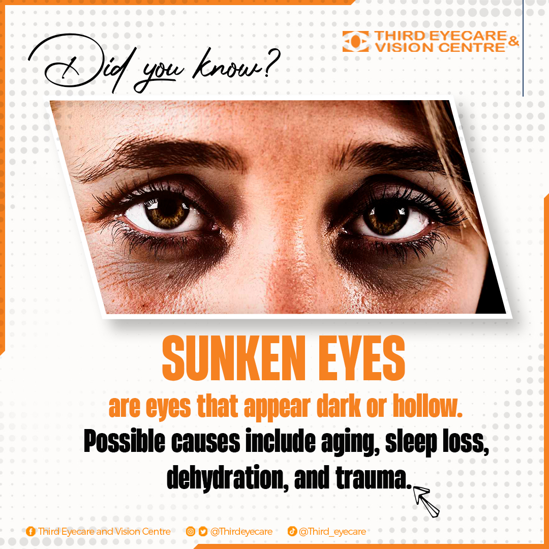thirdeyecare's tweet photo. There are several causes of sunken eyes but wearing glasses isn't one of them.
#thirdeyecare #besteyeclinicinghana #ghana #FactCheck #MythConceptions #FactsNotFiction #MondayVibes #StartTheWeekRight https://t.co/5MccU2B43b