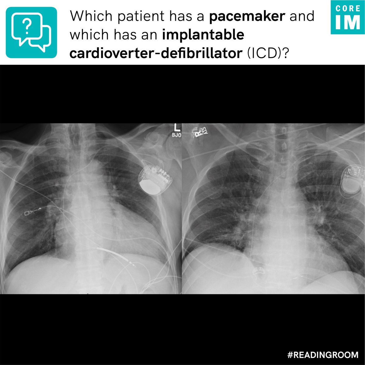 1/ To prep for the new pacemakers & ICDs episode this Wednesday, Which patient has a #pacemaker and which has an #ICD? 🧐 #ReadingRoom