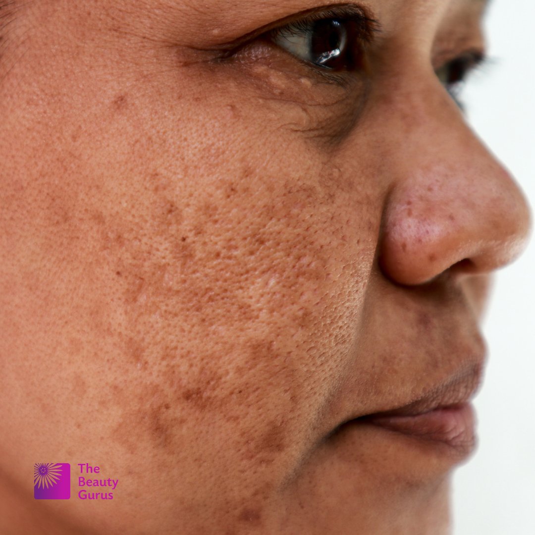 TheBeautyGurus's tweet photo. #UV rays can burn your skin all year round, causing sun damage and encouraging #wrinkles to form.

We can resurface the skin with an #Obagi peel, revealing a smooth and youthful complexion. 

Don't forget to use sunscreen to protect your glow and keep lines at bay. https://t.co/9njgUC28Vg
