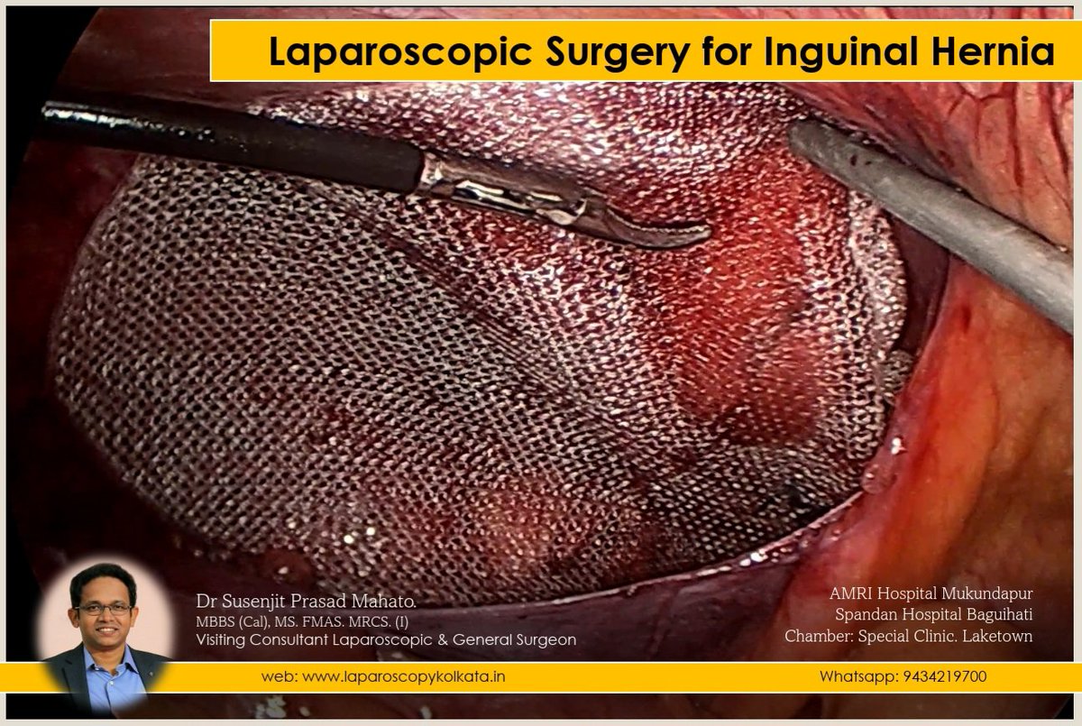 DrSusenjit's tweet photo. Laparoscopic Inguinal Hernia Surgery provides the following benefits : 
less pain, less scar, less blood loss &amp; less stay. The patient will enjoy a quick recovery.
#inguinalhernia, #herniasurgery, #TAPP, #lapsurgery, #laparoscopy, #laphernia, #laparoscopic
https://t.co/xXxBCAVl0h https://t.co/JQmYnXSfsT