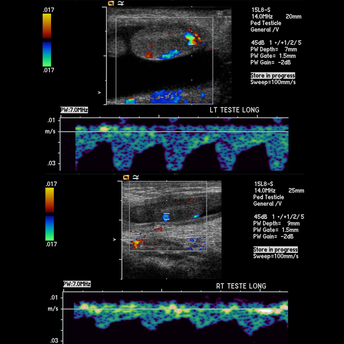 Pediatric Imaging (@pedsimaging) on Twitter photo Newborn with swollen left scrotum
US of testicles show an anechoic fluid collection around the left testicle. There is normal flow to both testicles
#FOAMed #FOAMPed #FOAMRad #PedsRad #RadEd #RadRes #PedUro #EmergencyMedicine #FOAMem #EMRad #FOAMus #USRad #Ultrasound Newborn with swollen left scrotum
US of testicles show an anechoic fluid collection around the left testicle. There is normal flow to both testicles
#FOAMed #FOAMPed #FOAMRad #PedsRad #RadEd #RadRes #PedUro #EmergencyMedicine #FOAMem #EMRad #FOAMus #USRad #Ultrasound