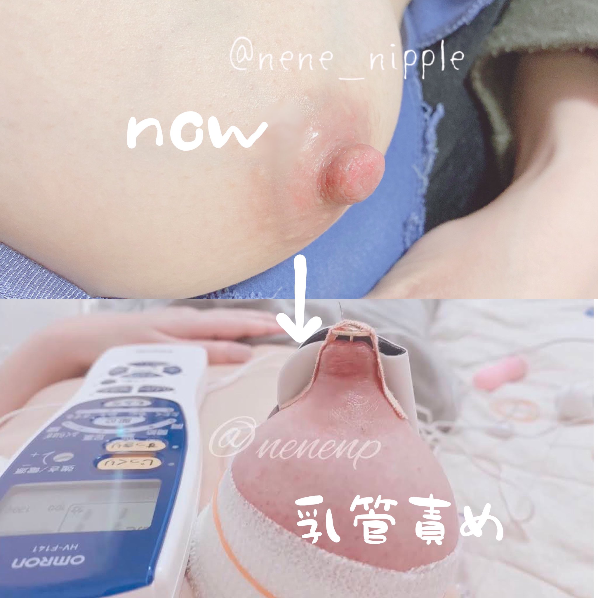 乳首　画鋲 久しぶりの私の乳首です。 乳管責めした乳首とビフォーアフターです。(アフターは過去画) おっぱいも乳首 も乳玉でパンパンですね♡乳管に挿入された画鋲が乳首の奥を刺激します。 乳管責めたくなってきました♡ 過去乳管責め画像、動画は↓  https://t.co ...