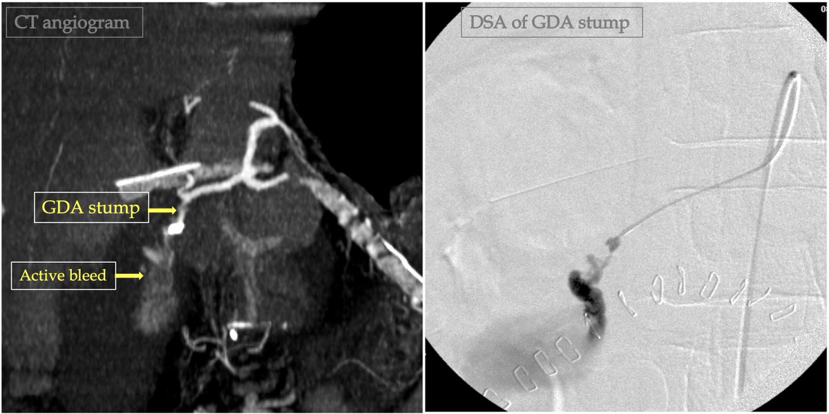 Marri_VIR's tweet photo. IR on call📟
Post whipple’s POD3 - Bleed
M.C. site - GDA stump
Mortality - 30-50%
Catastrophe - averted.
#irad #withoutascalpel #ISVIR #SIRRFS #medtwitter #pinholesurgery #Postopbleed https://t.co/oJnWYavtIC