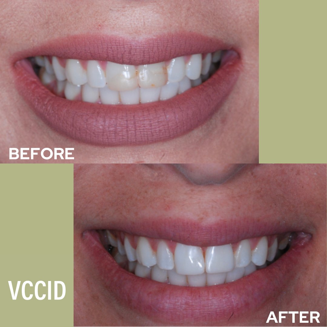 Check out these incredible before and after photos!

To get a pearly white #smile, we used composite #bonding for the front two teeth. 

Now they match the coloration of the neighbouring #teeth, and look stunning!

Contact us to book!
Phone: (604) 243-0048
Email: info@vccid.com