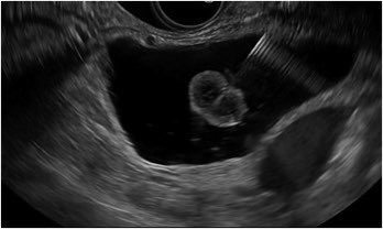 You’ve heard of a fishmouth papilla, but have you heard of the spearfishing sign? 
🐠 A new term to coin an observation of how to differentiate mucin from mural nodules in pancreatic cysts
Congrats <a href="/shifaumarMD/">Shifa Umar, MD</a>!
authors.elsevier.com/sd/article/S24…