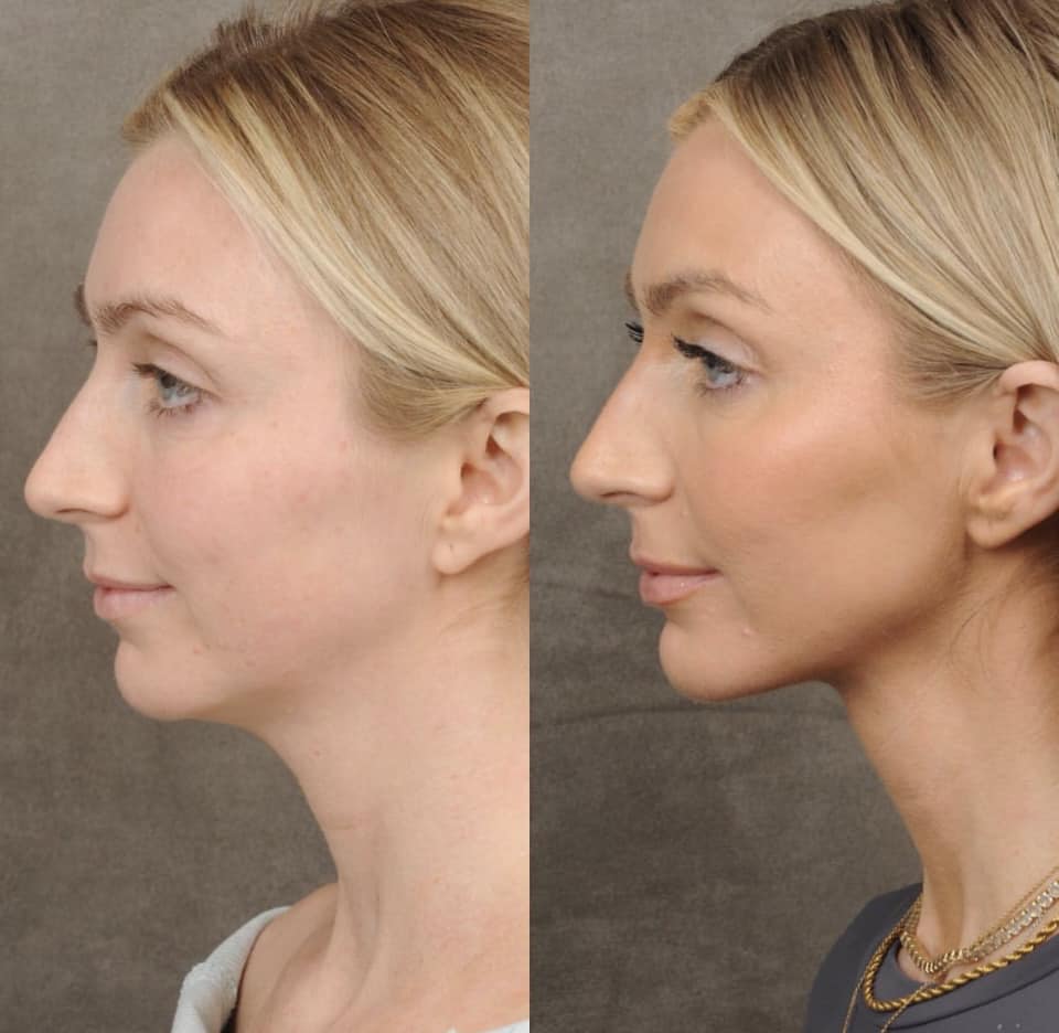 DrBenTalei's tweet photo. The loveliest @blakehealey is getting married soon, and we got to freshen her up with a weekend lift. This is an internal deep plane neck lift combined with Profound RF for skin tightening.
#weekendlift #necklift #profoundrf #drbentalei https://t.co/yIjcVYWo0I