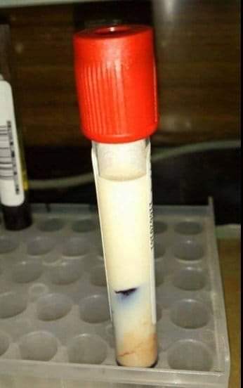 InformaCosmos's tweet photo. Aunque no lo creas esta es una muestra de sangre de un paciente con 5800 mg/dl de triglicéridos y 700 mg/dl de colesterol total. 

Podríamos decir que tenía un poquito de sangre en su grasa. 😬

📷: sumedico https://t.co/mA0eM9nI0Z