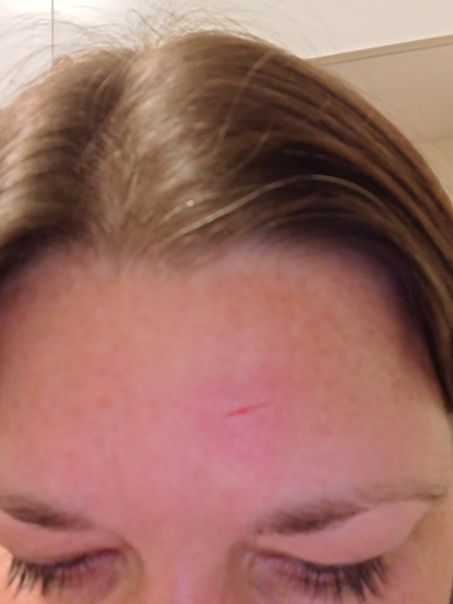 Jeg ville klø mig på panden. Glemte jeg havde en kniv i hånden. Jeg er 40 år🤦‍♀️