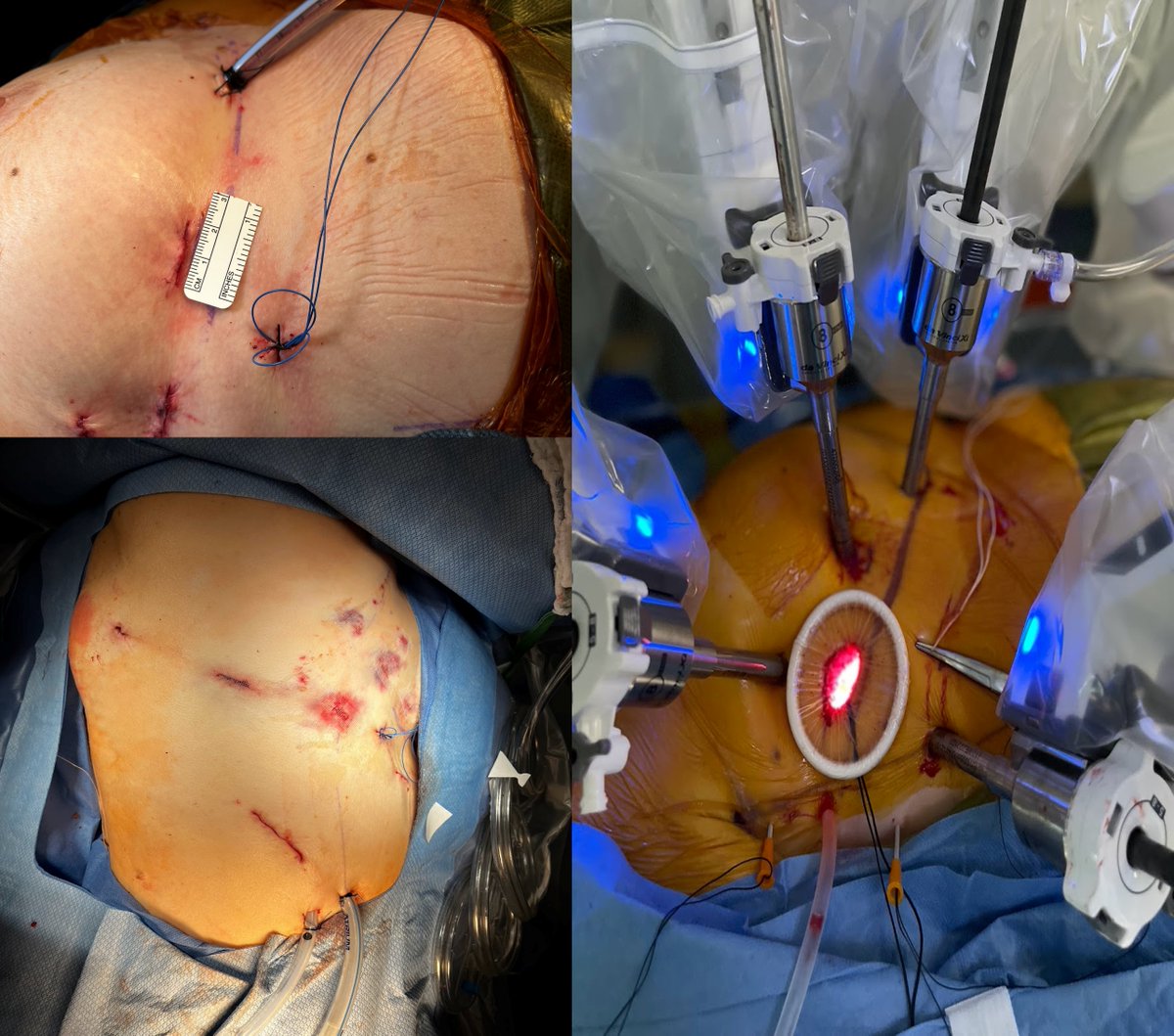 Danny (@dannyramzymd) on Twitter photo Combined Robotic mitral repair and right upper lobe resection for lung cancer.  Great collaboration between Cardiac and Thoracic Surgery @UTHeartvascular and @MemorialHermann Patient discharged on post operative day 3. Robotic surgery can help reduce length of stay for combined Combined Robotic mitral repair and right upper lobe resection for lung cancer.  Great collaboration between Cardiac and Thoracic Surgery @UTHeartvascular and @MemorialHermann Patient discharged on post operative day 3. Robotic surgery can help reduce length of stay for combined