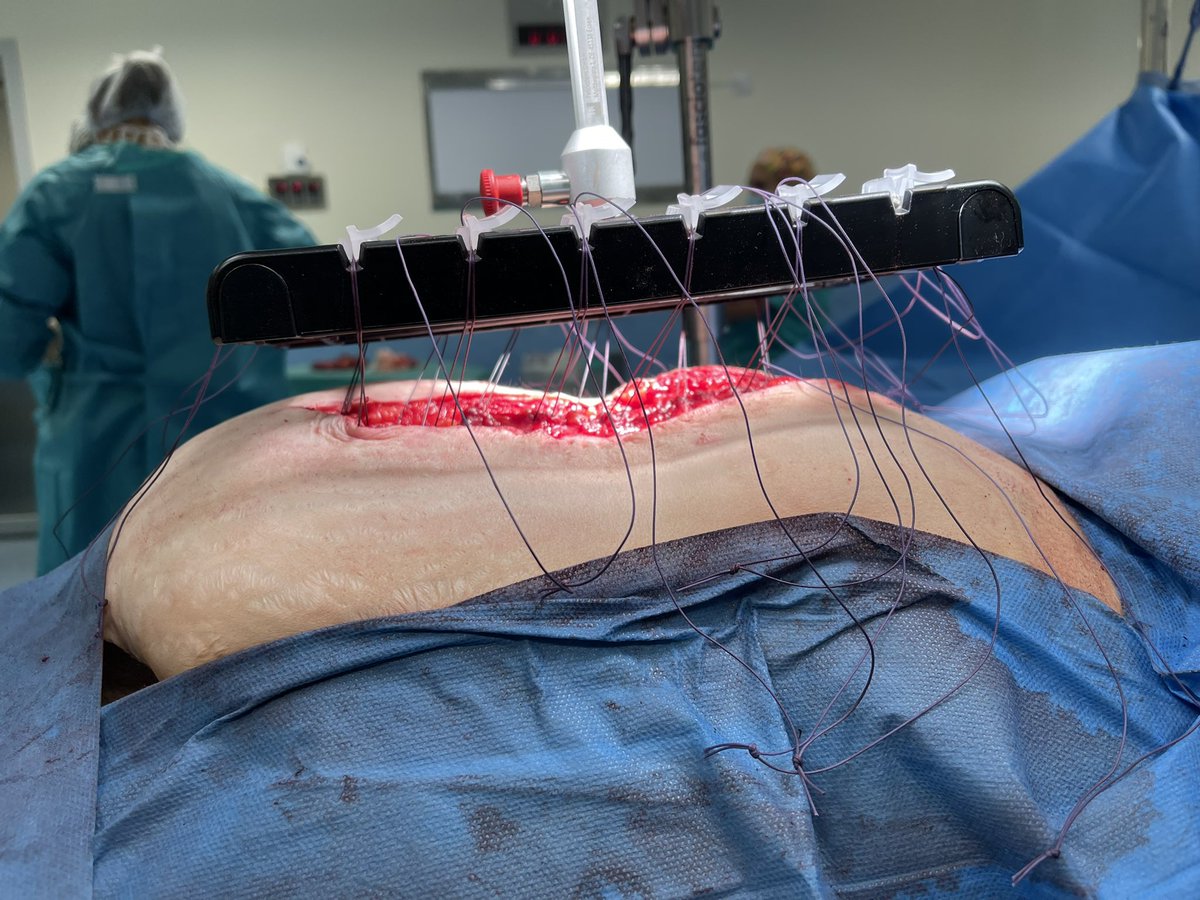 paredabdhuis's tweet image. El próximo 14 de Abril iniciamos el primero de una serie de workshops mostrando nuestros resultados con el uso del dispositivo de tracción fascial intraoperatoria Fasciotens.
@AecPared @CirujanosMad 
#fasciotens #incisionalhernia #abdominalwallsurgery