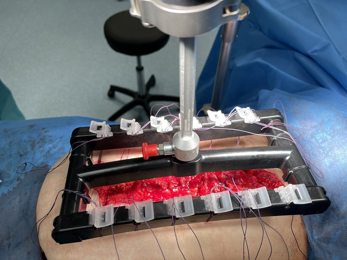 paredabdhuis's tweet image. El próximo 14 de Abril iniciamos el primero de una serie de workshops mostrando nuestros resultados con el uso del dispositivo de tracción fascial intraoperatoria Fasciotens.
@AecPared @CirujanosMad 
#fasciotens #incisionalhernia #abdominalwallsurgery