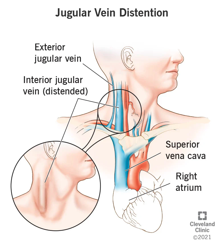 Our #GreysAnatomy patient has jugular vein distention is the bulging of the major veins in your neck. It's a key symptom of heart failure and other heart and circulatory problems.