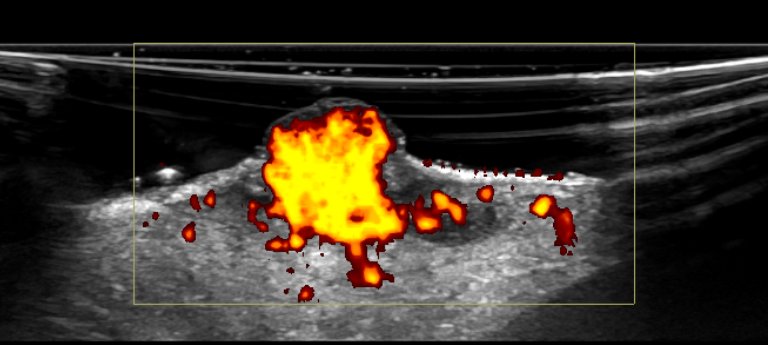 UW_MSKrad's tweet photo. #CaseOfTheWeek ‼️🎉‼️
☢️🩻☠️Case #15☠️🩻☢️
New case from @xradiasian‼️
#HandMass #ShortIntervalGrowth
➡️➡️➡️ Diagnosis❓❓
#MSKRad #FOAMrad #radres #MedEd #RadEd #OrthoTwitter #HandAndUpperExtremity #Derm @ssr_rwg @UWRadRes @HandSociety @AADskin https://t.co/ktzHOq54E3