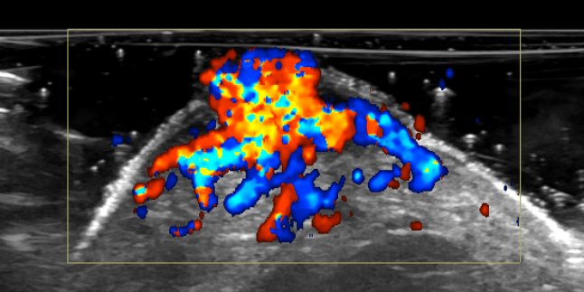 UW_MSKrad's tweet photo. #CaseOfTheWeek ‼️🎉‼️
☢️🩻☠️Case #15☠️🩻☢️
New case from @xradiasian‼️
#HandMass #ShortIntervalGrowth
➡️➡️➡️ Diagnosis❓❓
#MSKRad #FOAMrad #radres #MedEd #RadEd #OrthoTwitter #HandAndUpperExtremity #Derm @ssr_rwg @UWRadRes @HandSociety @AADskin https://t.co/ktzHOq54E3
