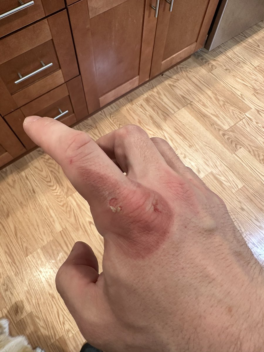 FlowGo37's tweet photo. #Burngate put a glove on to see what would happen. Skin peeling off is very metal. We push forward. #jobsnotfinished https://t.co/OtLjdzsBE9