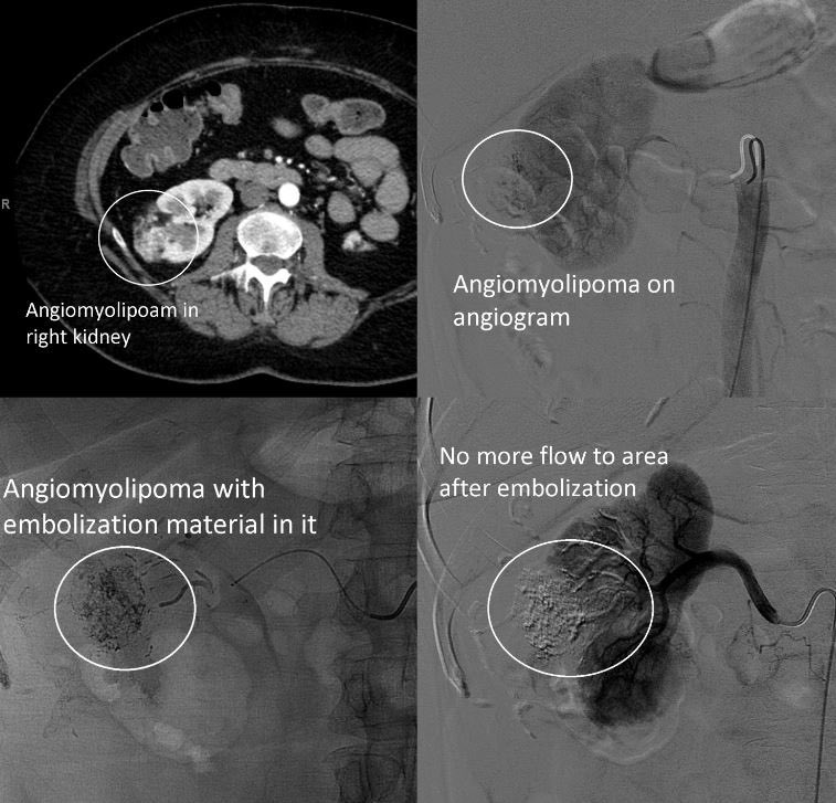 Benign angiomyolipoma (AML) on the right kidney, but these can rupture and cause life-threatening bleeding. The mass was embolized by interventional radiology (#IRad), which reduces the risk of bleeding.
