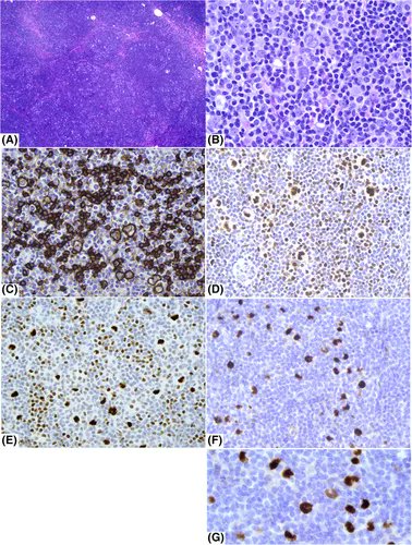 e_JHaem's tweet photo. Images in Haematology: MEF2B is the ideal immunohistochemical marker to highlight neoplastic LP cells in nodular lymphocyte-predominant Hodgkin lymphoma https://t.co/NVFzYicACh @fredhutch @UW
#lymsm #NLPHL https://t.co/T7TQFlOa1q