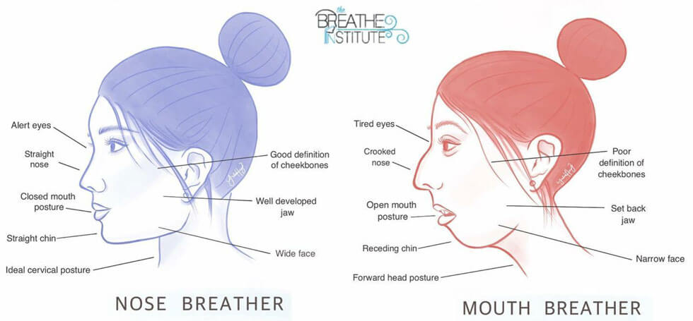 Mouth breathing has been shown to cause:
· ADHD
· Asthma
· Sleep disorders
· Chronic fatigue
· Alle