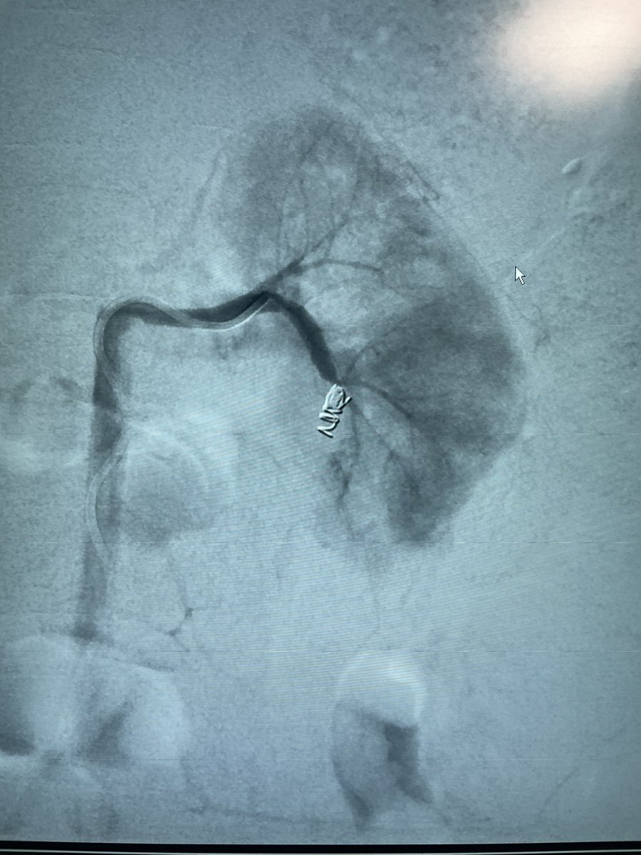 11 year old boy with left renal arteriovenous fistula, post percutaneous renal biopsy. Successfully embolized with two Interlock detachable coils. <a href="/AzzamKhankan/">Azzam Khankan عزام خانكان</a> <a href="/AtassiGhassan/">ghassan atassi</a> <a href="/AAlkenawi/">د. عبدالقادر القناوي</a> <a href="/DrMajedAbdulhaq/">Majed Abdulhaq</a> @SalmanFelemban
