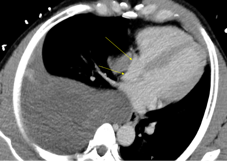 Small right atrium in right tension hemothorax. Hypotension and tachycardia improved significantly on chest tube placement.
Well described sign of pericardial tamponade on echo. Similar mechanism?
#FOAMed #radres