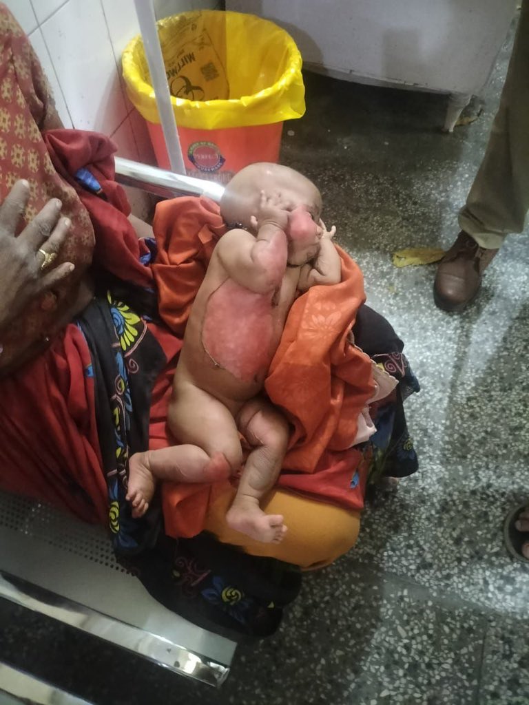 ASKUMASHANKAR's tweet photo. सुना है उत्तर प्रदेश सुरक्षित हाथों में है पता है यह फोटो कहाँ की है? उत्तरप्रदेश की… जहां हर एक शख्स बहुत सुरक्षित महसूस करता है. 

7 महीने की बच्ची है, माँ का रेप हुआ है और आरोपी केस वापस लेने के लिए पीड़िता को मारा-पीटा और उसकी बच्ची को भी जला दिया. यह यूपी के उन्नाव का मामला है.
@NOBCMAHSABHA @ULiveIndia @obc_uma