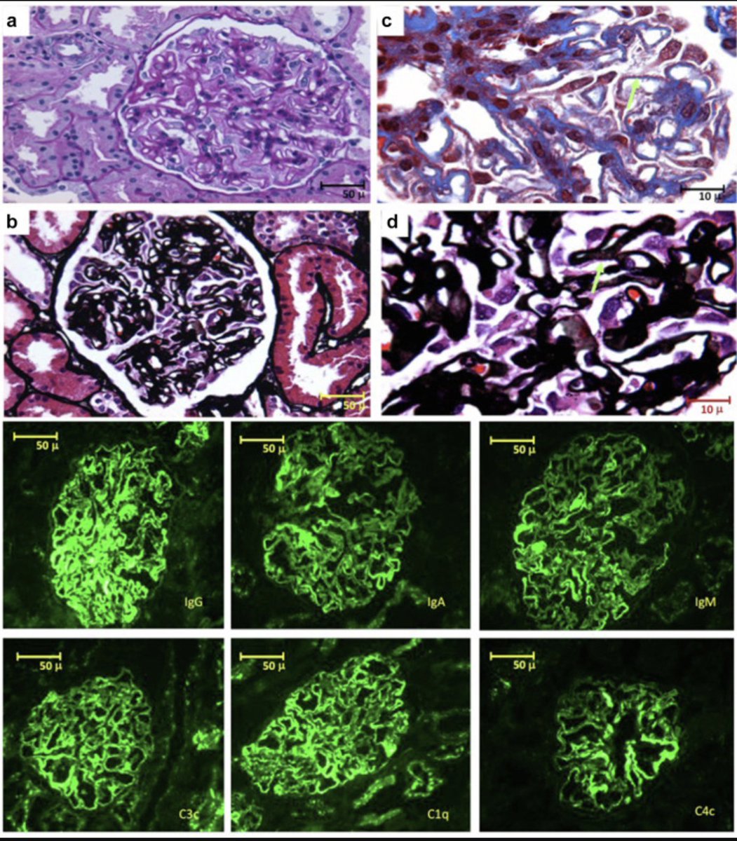 KIReports's tweet photo. Kidney-Limited Full-House Lupus-like Membranous Nephropathy and Membranoproliferative Glomerulonephritis in Pregnancy

https://t.co/UrAzvQHV2W

#Lupus #KIRNephrologyRounds https://t.co/ecwWDceZEE