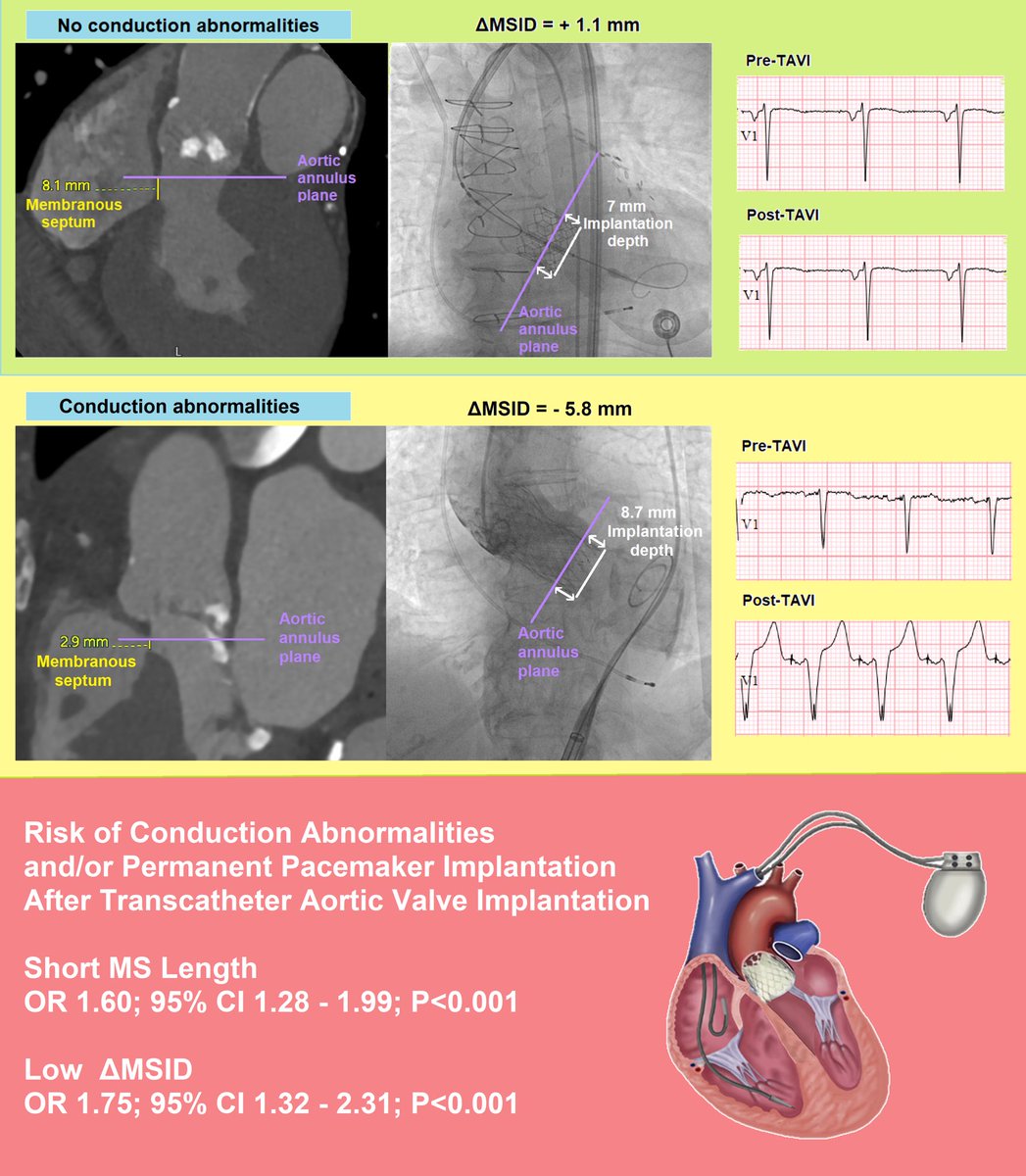 Michel Pompeu Sá (@m_pompeu_sa_md) on Twitter photo 🔥Hot off the press🔥 Just published in <a href="/ccijournal/">CCIjournal</a>: CT-derived membranous septum length and pacemaker implantation after #TAVI #TAVR onlinelibrary.wiley.com/doi/10.1002/cc…
💪<a href="/JefVandenEynde/">Jef Van den Eynde</a> <a href="/XanderJacquemyn/">Xander Jacquemyn</a> <a href="/ClavelLabo/">Labo Dr Clavel</a> <a href="/PPibarot/">Philippe Pibarot</a> <a href="/myocardiomegaly/">Harish Jarrett</a> <a href="/RobRodriguezMD/">Roberto Rodriguez, MD</a> <a href="/ScottGoldmanMD/">Scott Goldman</a> <a href="/BaselRamlawiMD/">Basel Ramlawi MD, FACC, FACS</a> 🔥Hot off the press🔥 Just published in <a href="/ccijournal/">CCIjournal</a>: CT-derived membranous septum length and pacemaker implantation after #TAVI #TAVR onlinelibrary.wiley.com/doi/10.1002/cc…
💪<a href="/JefVandenEynde/">Jef Van den Eynde</a> <a href="/XanderJacquemyn/">Xander Jacquemyn</a> <a href="/ClavelLabo/">Labo Dr Clavel</a> <a href="/PPibarot/">Philippe Pibarot</a> <a href="/myocardiomegaly/">Harish Jarrett</a> <a href="/RobRodriguezMD/">Roberto Rodriguez, MD</a> <a href="/ScottGoldmanMD/">Scott Goldman</a> <a href="/BaselRamlawiMD/">Basel Ramlawi MD, FACC, FACS</a>