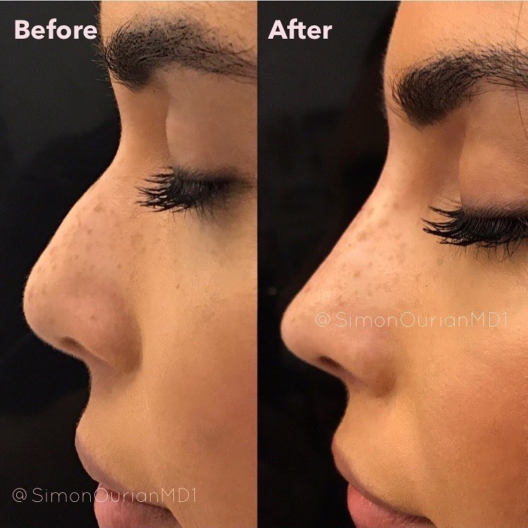 simonourianmd's tweet photo. Non-Surgical Nose Job
#nosejob #nosugery #nonsurgical #noselift #fillers #transformation #makeover #simonourian #epione https://t.co/5gGUJse73y