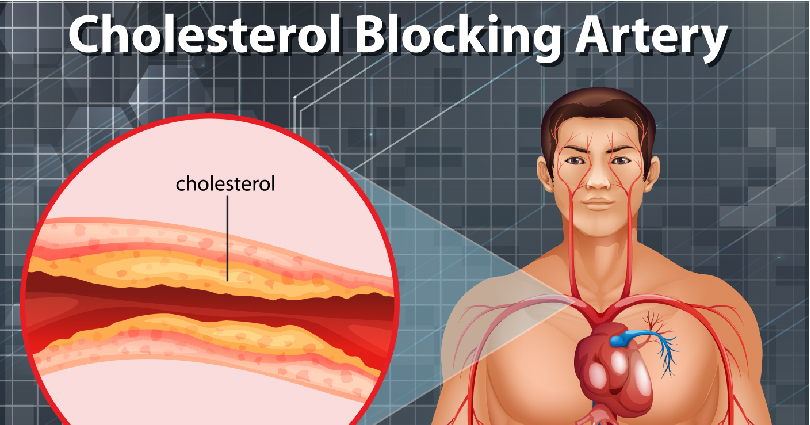 Read Article Here👉👉👉bit.ly/43zZwWz
If you’re concerned about your cholesterol levels, you may be wondering if there are any natural ways to lower them without resorting to medication. 
#cholesterol #healthylifestyle #HeadUpHigh #HealthForAll #healthcare