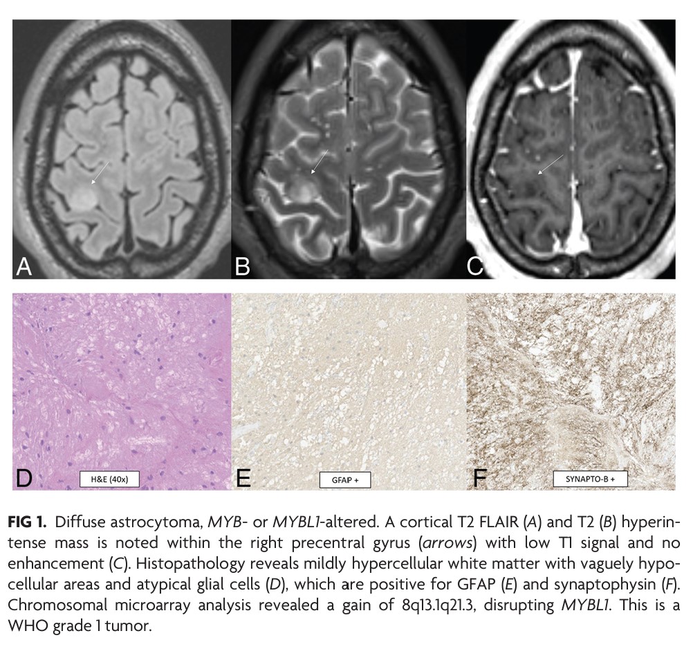 'Newly Recognized CNS Tumors in the 2021 World Health Organization Classification: Imaging Overview with Histopathologic and Genetic Correlation' #CNSTumors #OpenAccess #ReviewArticle | bit.ly/3UqWsaQ