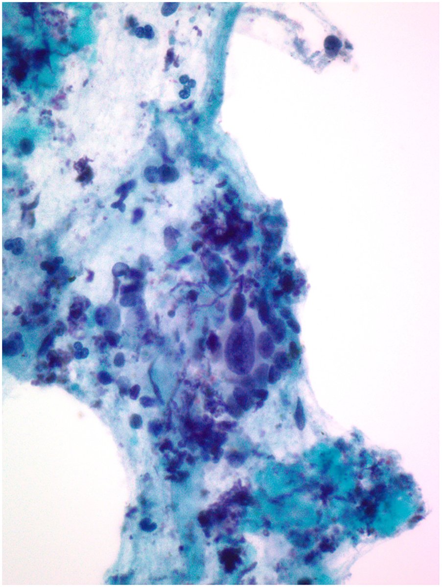 Featured in the April issue | The degree of cytologic atypia in autoimmune pancreatitis (AIP) can be moderate to severe, and the incidence of atypia is more common in type 2 AIP compared with type 1 AIP.

🔗 acsjournals.onlinelibrary.wiley.com/doi/10.1002/cn…

#CytoPath