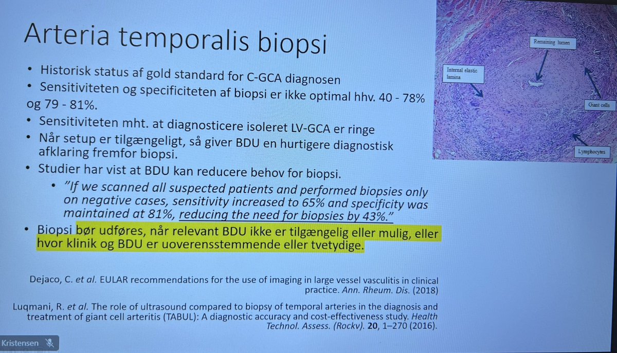 Staff Meeting #GiantCellArteritis = Arteritis Temporalis -Thx Dept Rheumatology @AalborgUH
Really important topic, vital for patients, full update for all clinicians, don’t rely on biopsy, think twice @ again👍
@Gigtforeningen @DanskePatienter @PatientSikkerhed @AAUsund @Reg_Nord