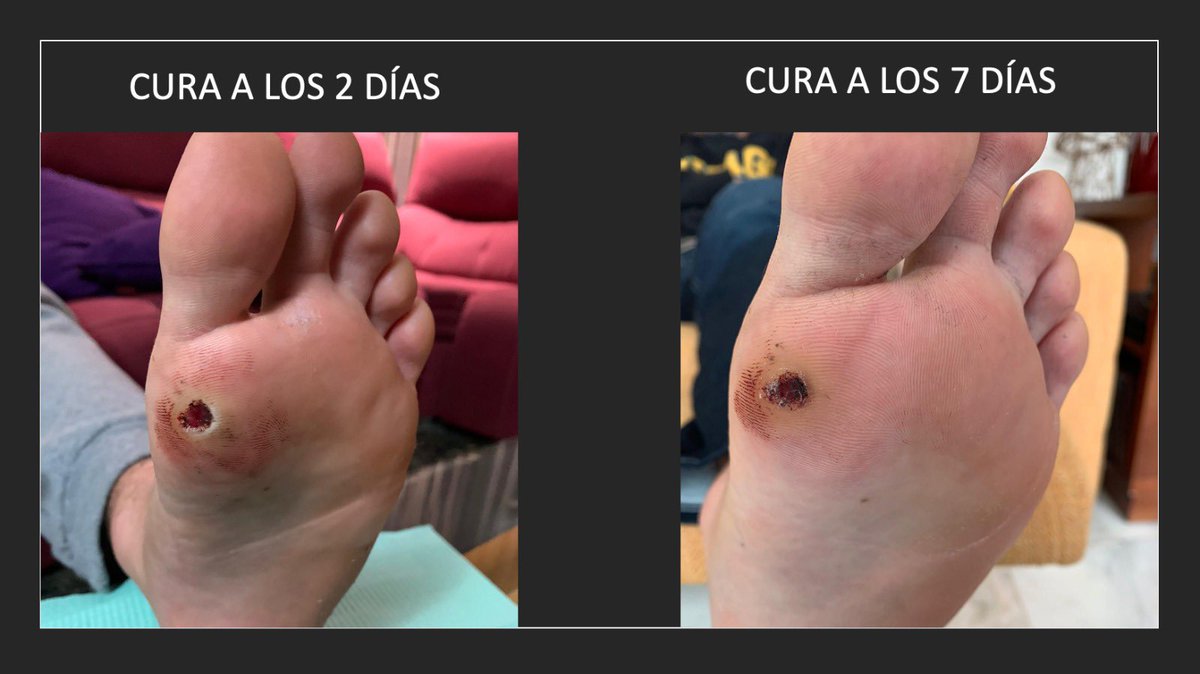 firesalut's tweet photo. Tratamiento definitivo para verruga plantar.
#FIRESALUT #podologia #verrugaplantar #verruga #tratamiento #pies #equipoFIRESALUT #somosFIRESALUT 

➕ℹ️
🔗 https://t.co/KoYJNstSea
📲 601 42 28 15
📩 info@firesalut.com https://t.co/2lOZrHMEUi