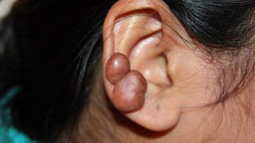 the_beardedsina's tweet photo. QUESTION OF THE DAY

Young woman comes to Hospital after noticing this on her Tummy &amp; Ear
she's worried her brother also has it. infection?

What is this?
What causes this?
Can it be treated?

Medical &amp; Non-medical folks
Don't forget to share, comment &amp; RT

Answers drop shortly https://t.co/COzTQJV1UD