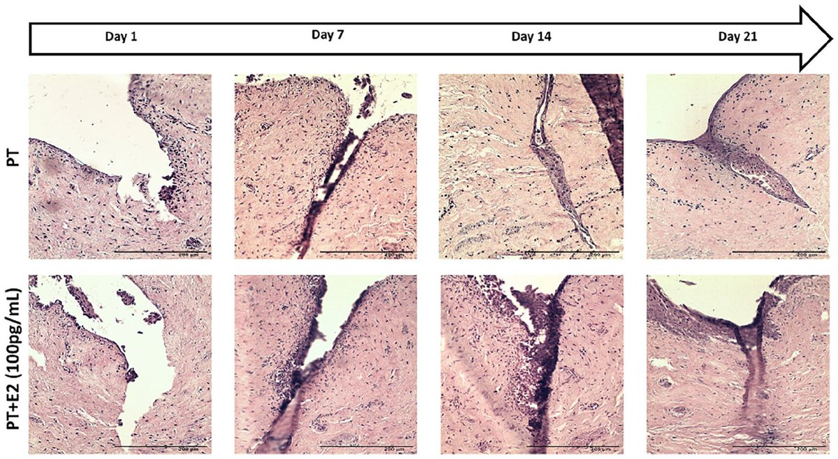 Journal of Tissue Engineering (@jtisseng) on Twitter photo 50% post-menopausal women experience urogenital disorders, especially due to reduced estrogen levels. This NEW work explores the wound-healing effects of Estradiol-17β in 3D vaginal wound cell models. READ: shorturl.at/bkNZ4 <a href="/sheffielduni/">The University of Sheffield</a> #WomensHealth #tissueengineering 50% post-menopausal women experience urogenital disorders, especially due to reduced estrogen levels. This NEW work explores the wound-healing effects of Estradiol-17β in 3D vaginal wound cell models. READ: shorturl.at/bkNZ4 <a href="/sheffielduni/">The University of Sheffield</a> #WomensHealth #tissueengineering
