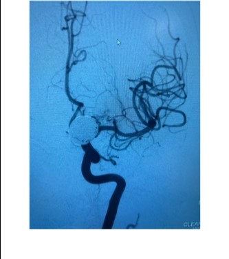 PenNeuro's tweet photo. US HCPs: 15mm A1 aneurysm stent-assisted coiling with #PC400 done by Dr. Raj Agrawal in Las Vegas. Thank you for sharing! #PC400 #PXSLIM #BMX96 #Aneurysm #Neurovascular Rx only. For risk info:โฏhttps://t.co/iWWO7Bfk2R Clinical results may vary. https://t.co/Z3fGzm6t9j