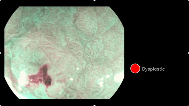 In a multicenter international study, Mohamed Hussein and colleagues use “Computer-aided characterization of early cancer in Barrett’s esophagus on i-scan magnification imaging.” Find it <a href="/GIE_Journal/">GIE</a>: bit.ly/3Gxx7Gm. #GITwitter #GIE #GIEJournal