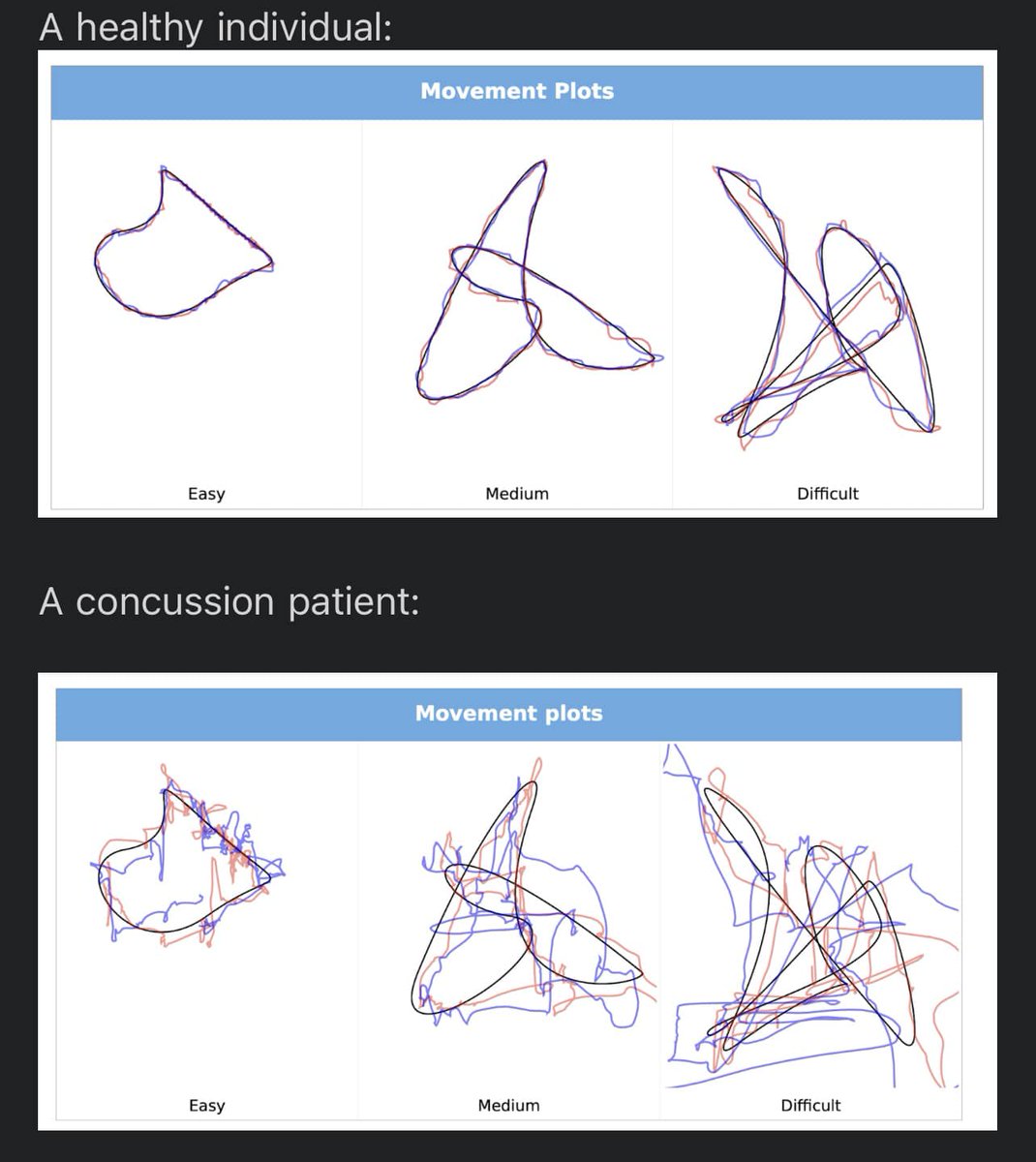 We are excited to welcome <a href="/MFNCChiroNeuro/">The Functional Neurology Center</a> to our customer base! So impressive to hear about their journey and expertise in treating Concussion and Brain Injuries! We at NeckCare are looking forward to supporting them in their mission! 
#cervicalspine #concussion #tbiawareness