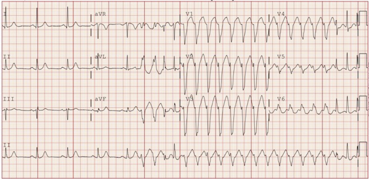 JACC Journals (@jaccjournals) on Twitter photo #JACCCaseReports Clinical Quiz: A 70 y/o male w/ 2-vessel #cvCAD and normal #LVEF comes w/ palpitations & dizziness.
Read more & vote below! #EPeeps #CardioTwitter <a href="/ArjunBGupta/">Arjun Gupta, MD, MPH</a> #JACCCaseReports Clinical Quiz: A 70 y/o male w/ 2-vessel #cvCAD and normal #LVEF comes w/ palpitations & dizziness.
Read more & vote below! #EPeeps #CardioTwitter <a href="/ArjunBGupta/">Arjun Gupta, MD, MPH</a>