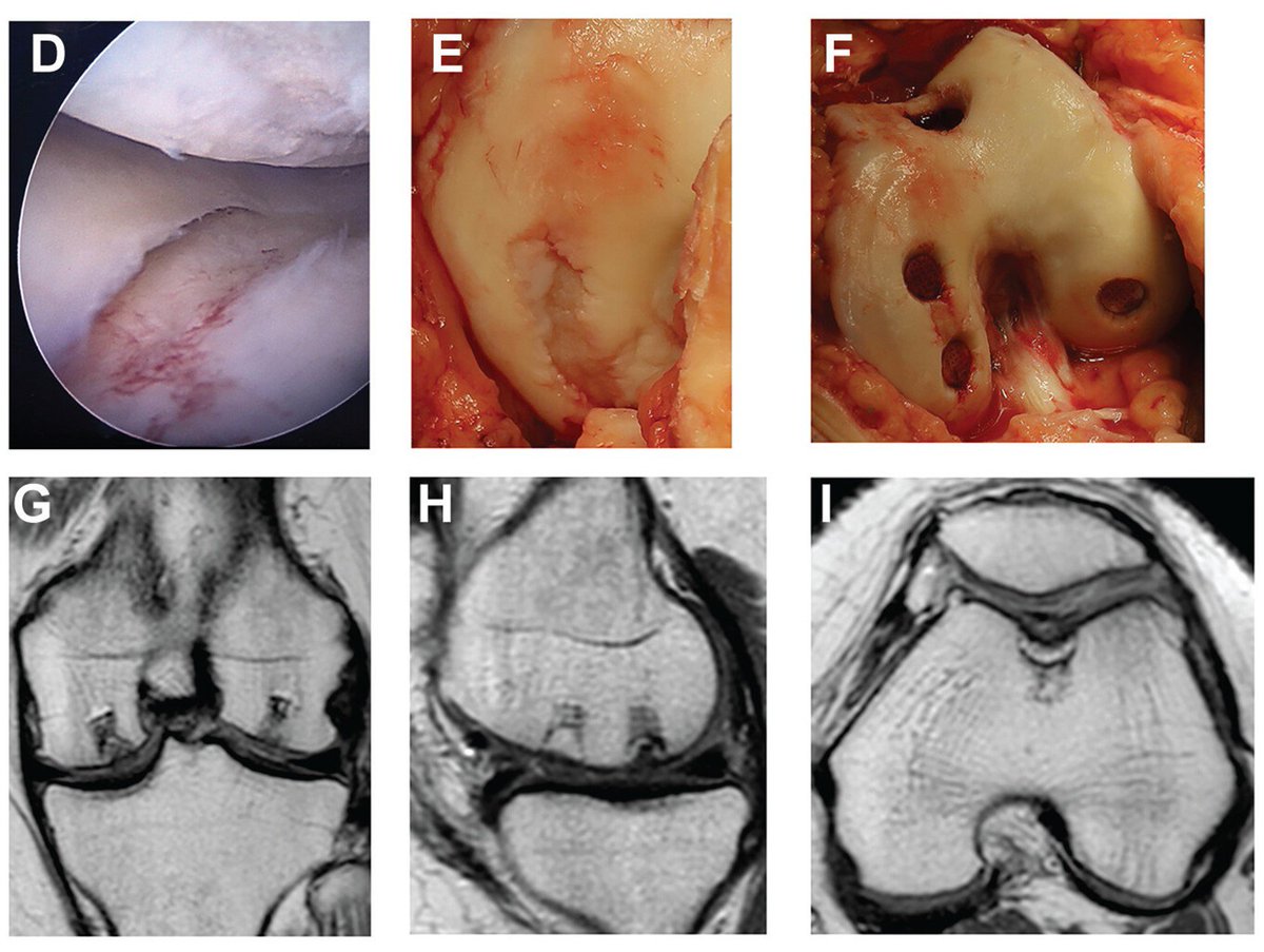 aossmjournals's tweet photo. An aragonite-based scaffold found safe and effective in the treatment of chondral and 
#OsteochondralDefect in the knee. Is it superior to #microfracture? @HumanitasMilano 
https://t.co/EpzOhtNBQz https://t.co/mGMs6nSC1E