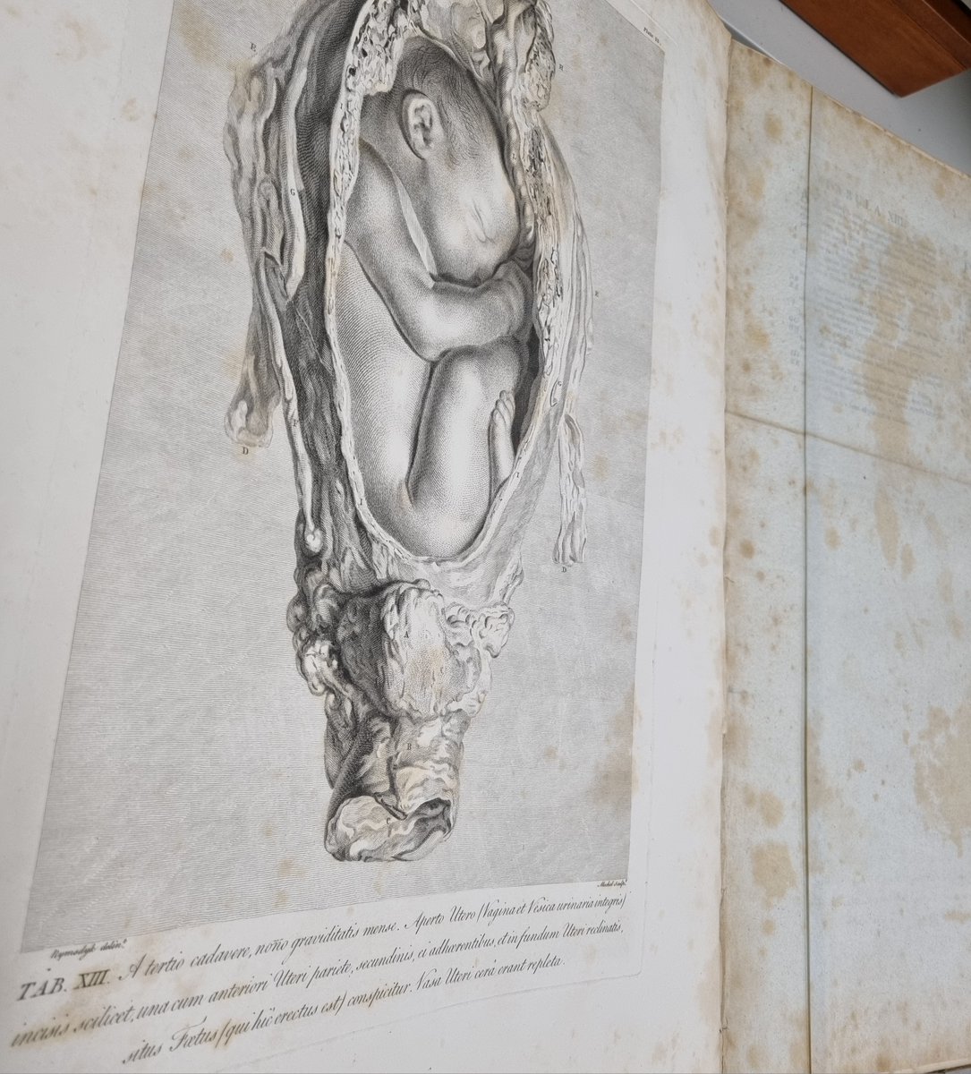 CollectionsSGUL's tweet photo. This tape had been used to 'fix' the spine of a rare book in our collection, William Hunter's Anatomy of the Human Gravid Uterus, 1774
Sellotape degrades over time and can become a proper #ConservationNightmare - never a #ConservationWin!
#Archive30 https://t.co/ZL29K22FkT