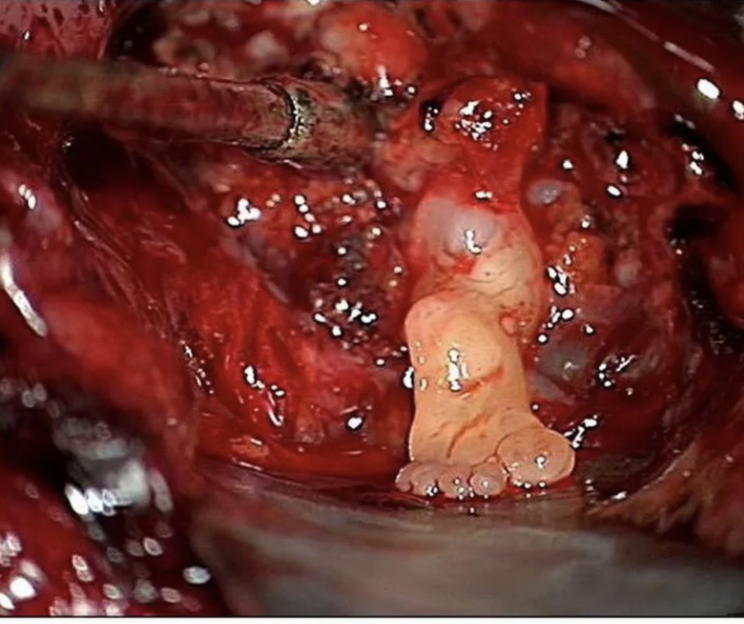 You are doing brain tumor surgery and you see this… what is your reaction?