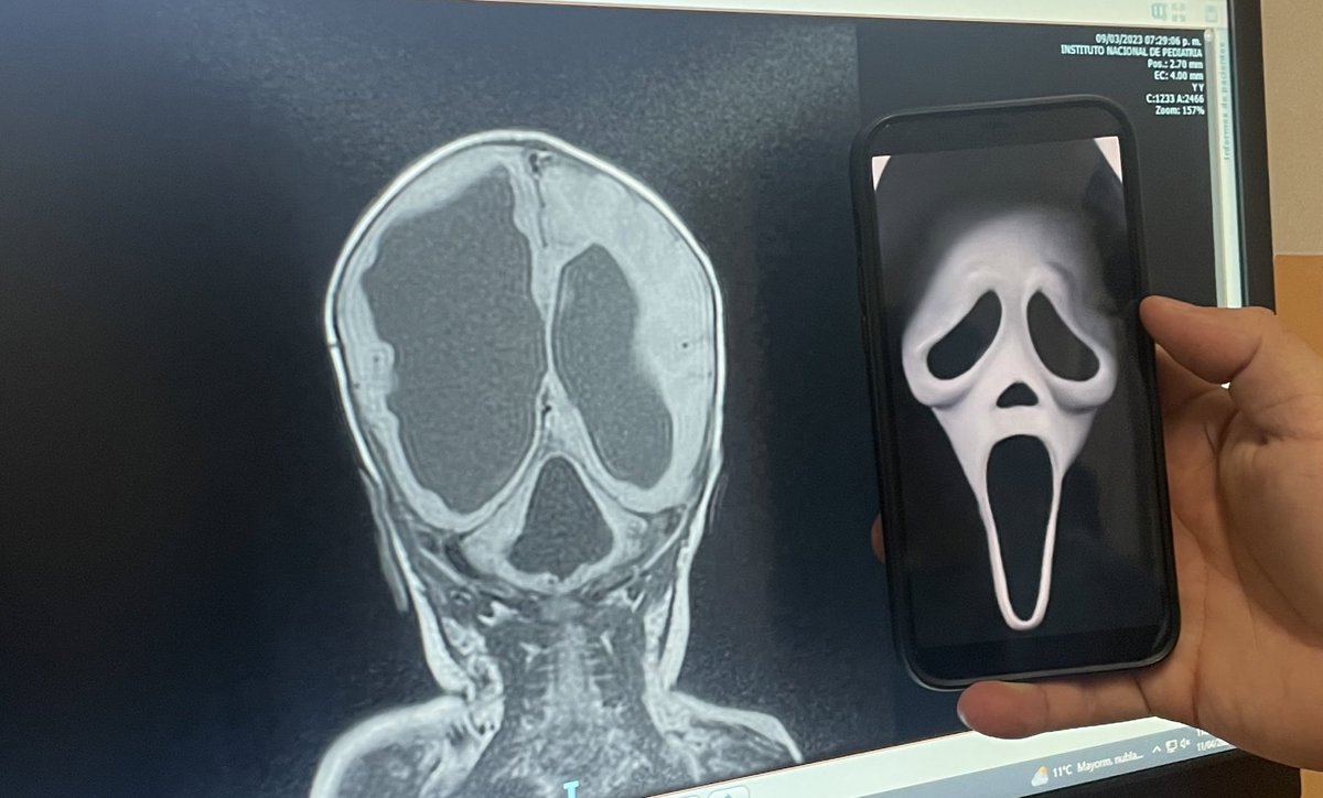 gcmarhx's tweet photo. Scream Sign en Hidrocefalia Congénita 🤣 https://t.co/Cnt5iX1CnF
