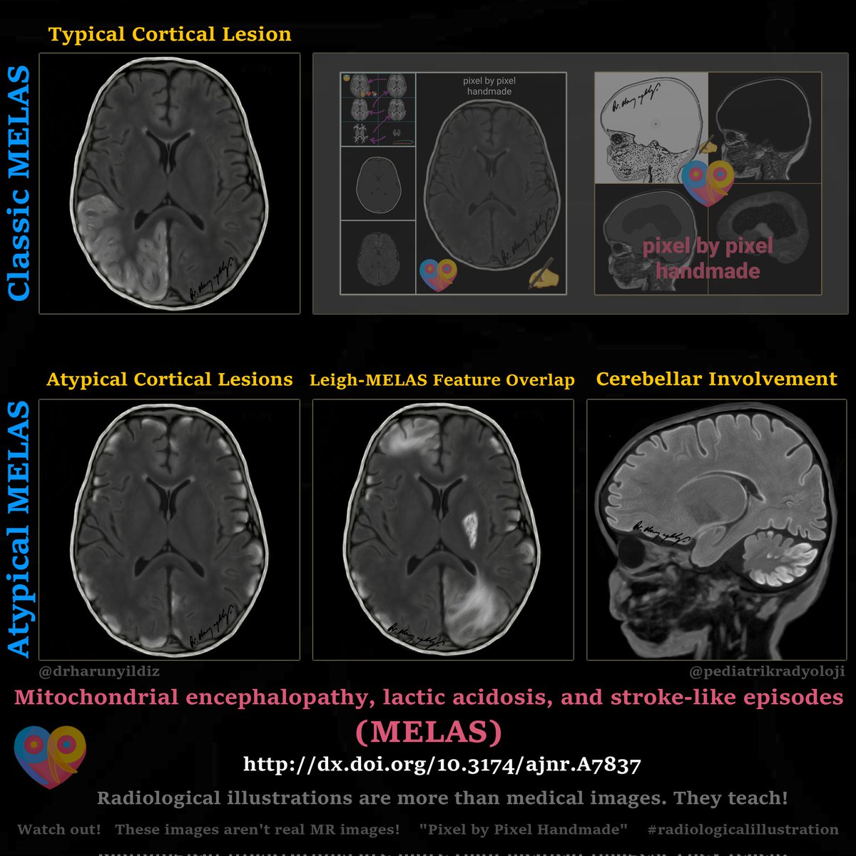 Mitochondrial encephalopathy, lactic acidosis and stroke-like episodes (MELAS) 

dx.doi.org/10.3174/ajnr.A… 

#radiologicalillustration ✍️