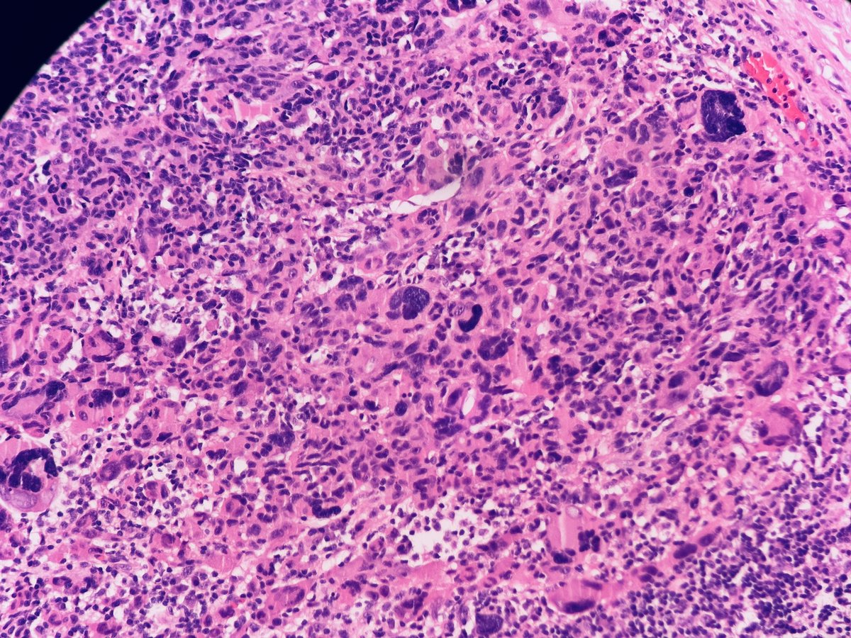HENRYY_MD's tweet photo. Another melanoma comes across my scope … see, they come in all kinds of shapes and forms, but they are all BAD! This one I guess show dedifferentiation ( sarcomatous changes) , lost melanocytic markers in deeper components ( lost PRAME too)
#dempath
@TristanRutland7 @PIorfino https://t.co/e24Z3PXTCw